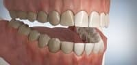 Bleaching Vorher Nachher