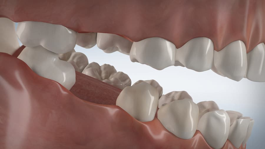 Video Zahnverlust 360°zahn Zahnarzt Düsseldorf