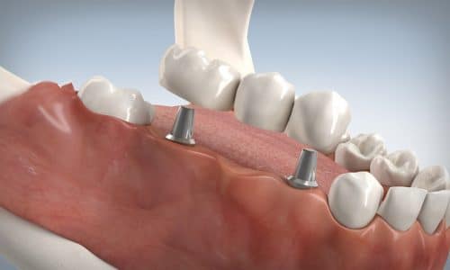 Implantatgetragene Brücke