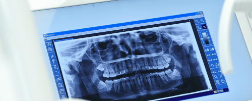 Wurzelbehandlung bei Zahnarzt