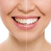 Veneers Düsseldorf - Schöne Zähne mit Veneersbehandlung