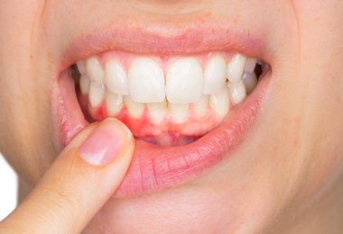 Patientin mit Zahnfleischbluten