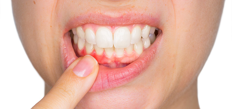 Patientin mit Zahnfleischbluten