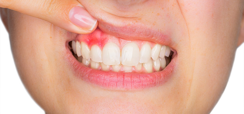 Patientin mit Zahnfleischentzündung