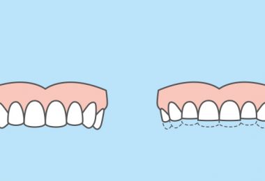 Zähneknirschen Illustration