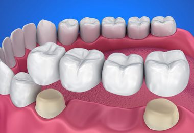Zahnlücke und Zahnersatz