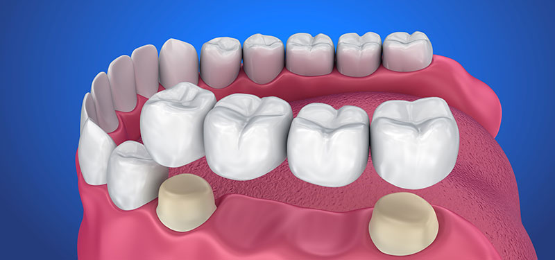 Zahnlücke und Zahnersatz