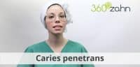 Video - Caries penetrans