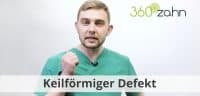 Video - Keilförmiger Defekt