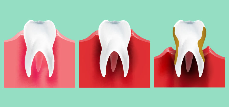 Zahnfleischrückgang Behandlung