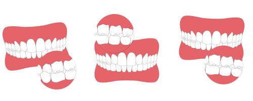 Die häufigsten Zahnfehlstellungen
