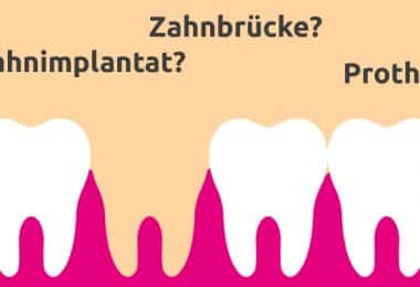 Alternative Zahnimplantat Illustration