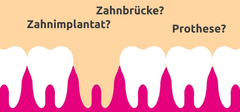 Alternative Zahnimplantat Illustration