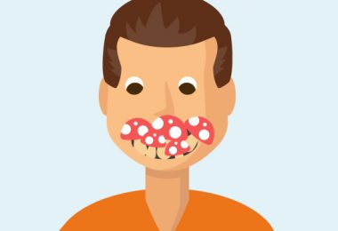 Pilzinfektion im Mund
