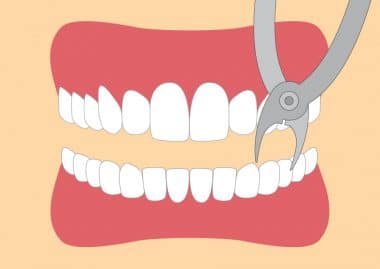 Zahn ziehen | Alles was Sie wissen müssen | 360°zahn